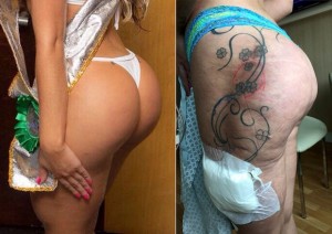 O bumbum de Andressa no passado, à esquerda, e à direita com a inflamação (Foto: Divulgação - Instagram / Reprodução - AKM-GSI / AKM-GSI)